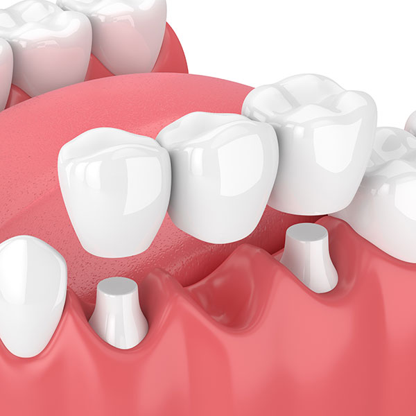 DentalBridges